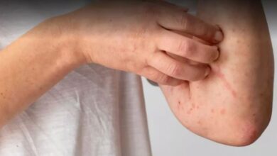 Photo of गर्मी में घमौर‍ियों ने कर द‍िया है परेशान, तो आजमाएं 5 घरेलू नुस्खे